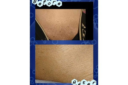 Vライン30代ビフォーアフター